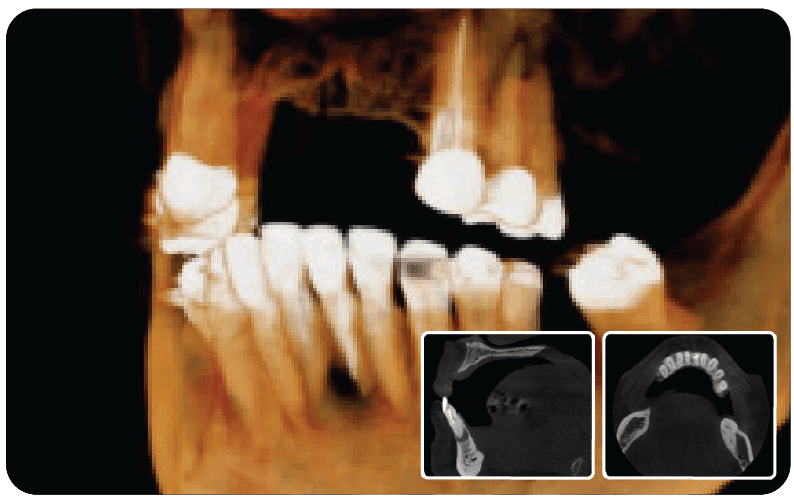 SAEVO SXR 3D CBCT Image 3dB